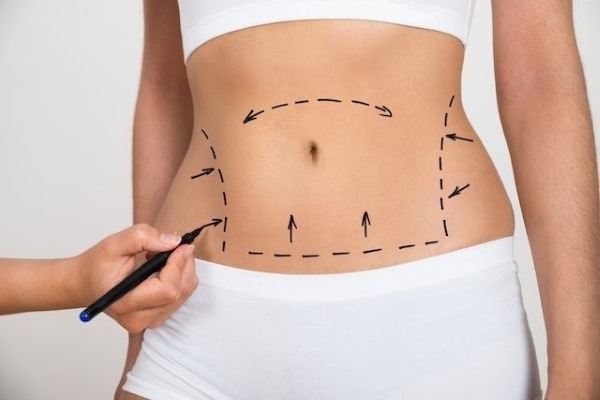 Abdominoplasty của bụng. Thao tác này là gì, nó được thực hiện như thế nào, trước và sau khi chụp ảnh, chỉ định và chống chỉ định, hậu quả