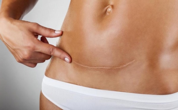 Abdominoplasty của bụng. Thao tác này là gì, nó được thực hiện như thế nào, trước và sau khi chụp ảnh, chỉ định và chống chỉ định, hậu quả