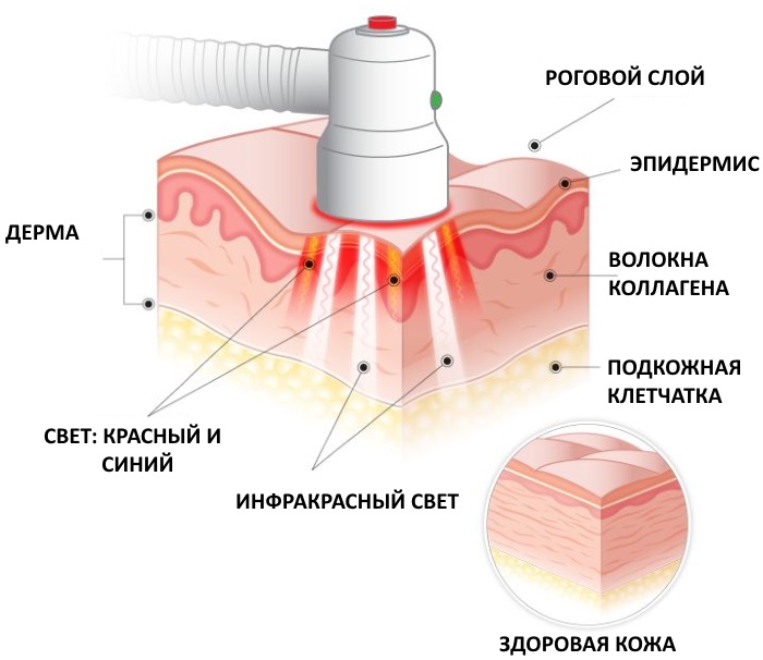 Liệu pháp quang động trong thẩm mỹ. Quy trình, chỉ định và hiệu quả ra sao