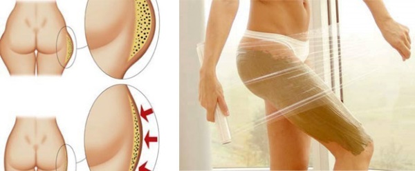 Làm thế nào để nhanh chóng loại bỏ cellulite ở dưới và chân: quấn, xoa bóp, tập thể dục