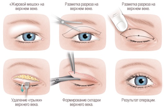 Como se livrar do século que se aproxima em casa. Métodos tradicionais, procedimentos cosméticos, cirurgia, cremes e pomadas