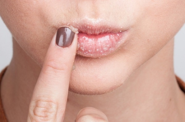 Làm thế nào để môi căng mọng với ly, chai, trang điểm, các bài tập nâng môi tại nhà