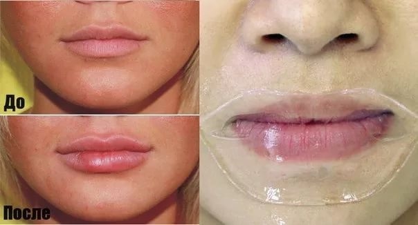 Làm thế nào để môi căng mọng với ly, chai, trang điểm, các bài tập nâng môi tại nhà