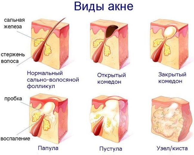 Lactofiltrum cho mụn trứng cá: nhận xét của bác sĩ da liễu với hình ảnh trước và sau. Hướng dẫn sử dụng, chất tương tự, giá cả