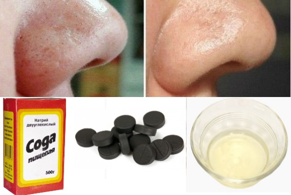 Mặt nạ với baking soda trị nếp nhăn, mụn trứng cá, mụn đầu đen, đồi mồi. Công thức nấu ăn và sử dụng tại nhà
