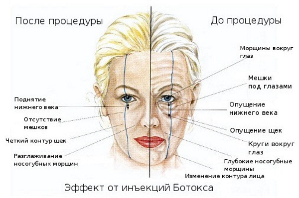 Giải phẫu cơ mặt người trong ngành thẩm mỹ tiêm botox. Lược đồ có mô tả và hình ảnh bằng tiếng Latinh và tiếng Nga