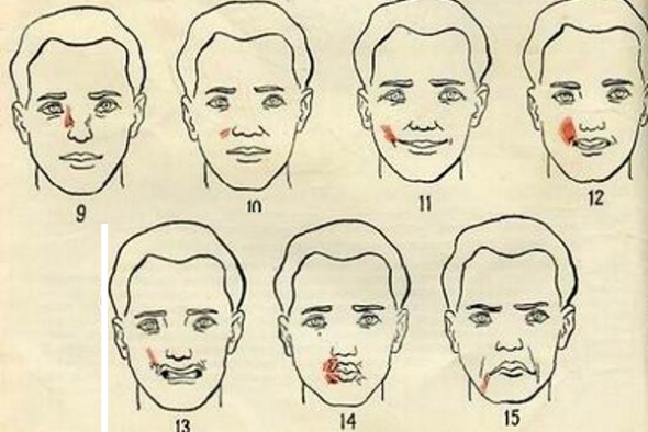Giải phẫu cơ mặt người trong ngành thẩm mỹ tiêm botox. Lược đồ có mô tả và hình ảnh bằng tiếng Latinh và tiếng Nga