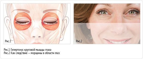 Giải phẫu cơ mặt người trong ngành thẩm mỹ tiêm botox. Lược đồ có mô tả và hình ảnh bằng tiếng Latinh và tiếng Nga