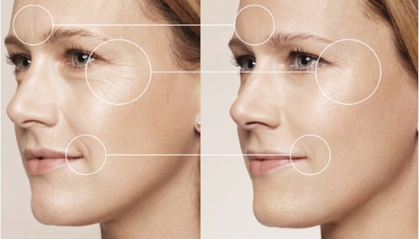 Giải phẫu cơ mặt người trong ngành thẩm mỹ tiêm botox. Lược đồ có mô tả và hình ảnh bằng tiếng Latinh và tiếng Nga