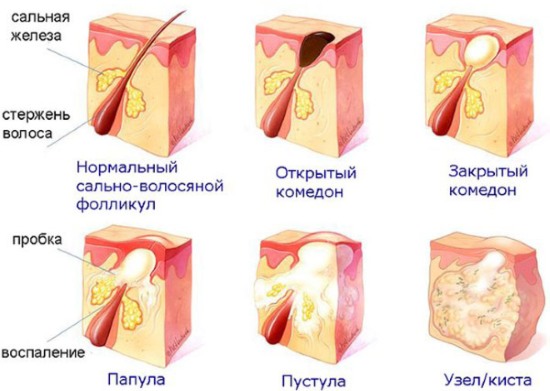 Mụn dưới da trên mặt. Lý do làm thế nào để thoát khỏi. Điều trị nhanh chóng bằng các biện pháp dân gian, thuốc mỡ, thuốc tại nhà