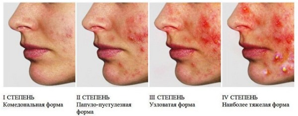 Mụn dưới da trên mặt. Lý do làm thế nào để thoát khỏi. Điều trị nhanh chóng bằng các biện pháp dân gian, thuốc mỡ, thuốc tại nhà