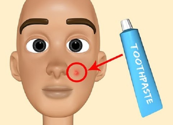 Cách bôi kem đánh răng trị mụn trên mặt. Công thức chuẩn bị và sử dụng, ảnh