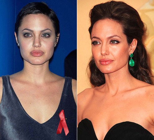 Angelina Jolie trước và sau khi phẫu thuật thẩm mỹ. Tuyển tập những bức ảnh của nữ diễn viên trước và sau khi phẫu thuật nâng mũi, nâng mũi plasma
