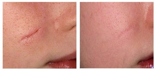 Thiết bị để loại bỏ các đốm đồi mồi, sẹo, hình xăm trên da mặt và cơ thể. Laser, Fraxel, Elos, M22. Đánh giá và đánh giá