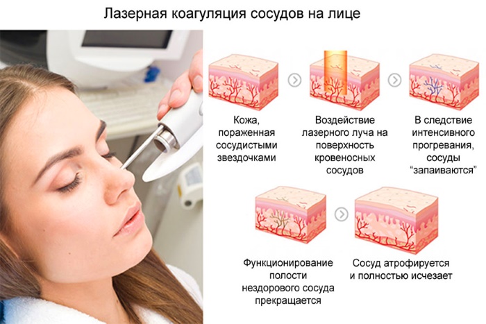 Thiết bị để loại bỏ các đốm đồi mồi, sẹo, hình xăm trên da mặt và cơ thể. Laser, Fraxel, Elos, M22. Đánh giá và đánh giá