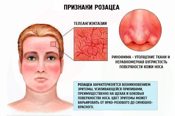 Thiết bị để loại bỏ các đốm đồi mồi, sẹo, hình xăm trên da mặt và cơ thể. Laser, Fraxel, Elos, M22. Đánh giá và đánh giá