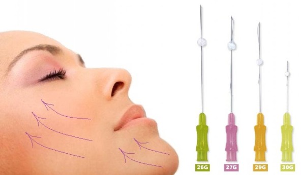 Tăng cường sinh học da mặt - nó là gì, các loại, quy trình được thực hiện như thế nào với axit hyaluronic, chỉ, chất làm đầy, thuốc. Ảnh và hậu quả