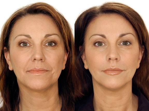 Tái tạo sức sống sinh học cho khuôn mặt là gì, nó khác gì với liệu pháp mesotherapy, chất làm đầy. Chỉ định, chống chỉ định, hậu quả. Một bức ảnh