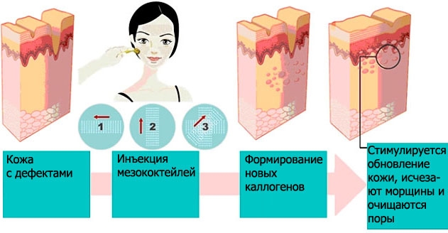 Tái tạo sức sống sinh học cho khuôn mặt là gì, nó khác gì với liệu pháp mesotherapy, chất làm đầy. Chỉ định, chống chỉ định, hậu quả. Một bức ảnh