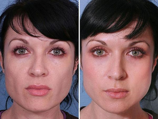 Tái tạo sức sống sinh học cho khuôn mặt là gì, nó khác gì với liệu pháp mesotherapy, chất làm đầy. Chỉ định, chống chỉ định, hậu quả. Một bức ảnh