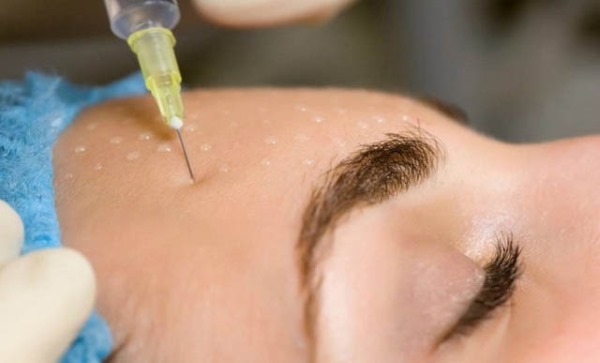 Tái tạo sức sống sinh học cho khuôn mặt là gì, nó khác gì với liệu pháp mesotherapy, chất làm đầy. Chỉ định, chống chỉ định, hậu quả. Một bức ảnh