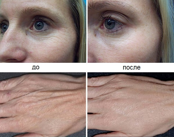Tái tạo sức sống sinh học cho khuôn mặt là gì, nó khác gì với liệu pháp mesotherapy, chất làm đầy. Chỉ định, chống chỉ định, hậu quả. Một bức ảnh