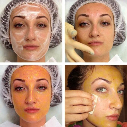 Ferul peel - nó là gì, nó được thực hiện như thế nào, axit, quy trình của quy trình Medderma, đánh giá, ảnh và kết quả