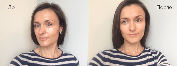 Ferul peel - nó là gì, nó được thực hiện như thế nào, axit, quy trình của quy trình Medderma, đánh giá, ảnh và kết quả
