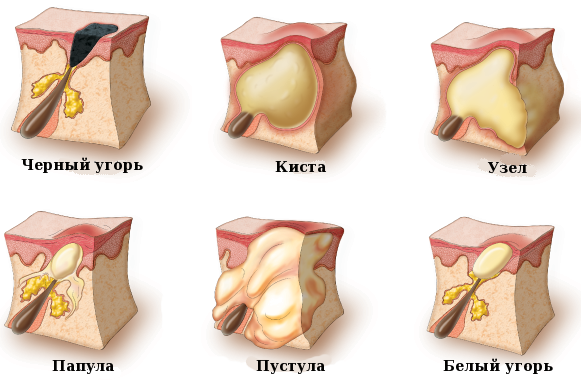Ferul peel - nó là gì, nó được thực hiện như thế nào, axit, quy trình của quy trình Medderma, đánh giá, ảnh và kết quả