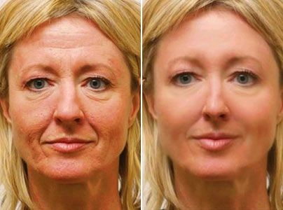 Ferul peel - nó là gì, nó được thực hiện như thế nào, axit, quy trình của quy trình Medderma, đánh giá, ảnh và kết quả