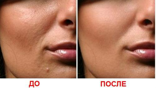 Mesoterapi muka pecahan - apa itu, bagaimana ia dilakukan, keberkesanan parut, kesan regangan, beg di bawah mata, harga kursus, gambar sebelum dan selepas, ulasan