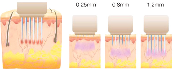Mesoterapi pecahan muka - apakah itu, bagaimana ia dilakukan, keberkesanan parut, kesan regangan, beg di bawah mata, harga kursus, gambar sebelum dan selepas, ulasan