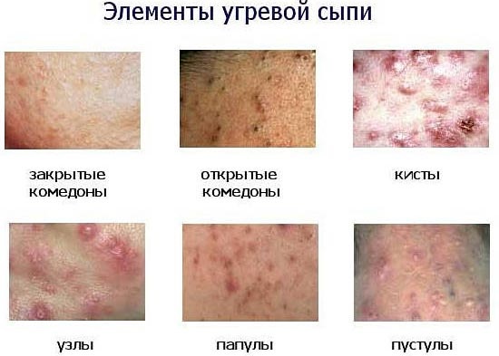 Làm thế nào để nhanh chóng hết mụn cám và mụn đầu đen trên mặt. Chế độ ăn uống, biện pháp dân gian, thuốc mỡ, kem
