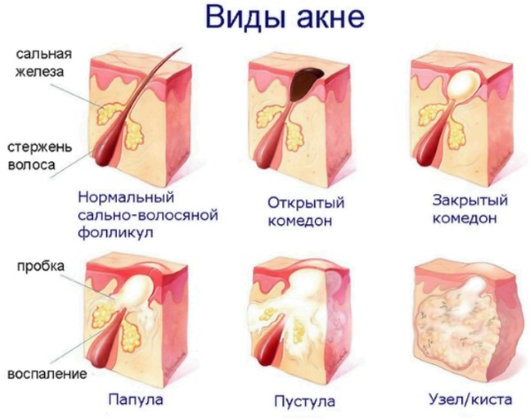 Làm thế nào để nhanh chóng hết mụn cám và mụn đầu đen trên mặt. Chế độ ăn uống, biện pháp dân gian, thuốc mỡ, kem