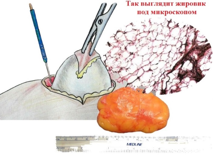 Làm thế nào để thoát khỏi wen trên mặt. Thuốc mỡ, kem, thuốc chữa bệnh, công thức dân gian và biện pháp khắc phục