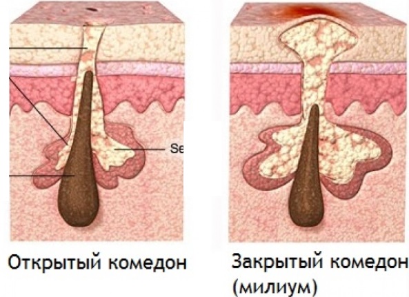 Làm thế nào để thoát khỏi wen trên mặt. Thuốc mỡ, kem, thuốc chữa bệnh, công thức dân gian và biện pháp khắc phục