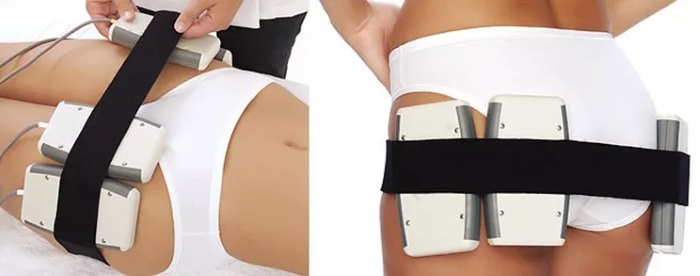 Lipolisi laser: cos'è, come si fa, indicazioni e controindicazioni. Recensioni di medici e pazienti, foto