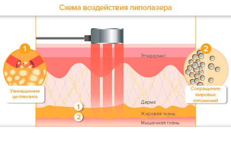 Lipolisi laser: cos'è, come si fa, indicazioni e controindicazioni. Recensioni di medici e pazienti, foto