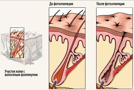 Penyingkiran rambut laser semasa kehamilan dan penyusuan, awal, lewat. Adakah mungkin atau tidak, pendapat doktor