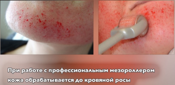 Mesoterapi muka pecahan - apa itu, bagaimana ia dilakukan, keberkesanan parut, kesan regangan, beg di bawah mata, harga kursus, gambar sebelum dan selepas, ulasan