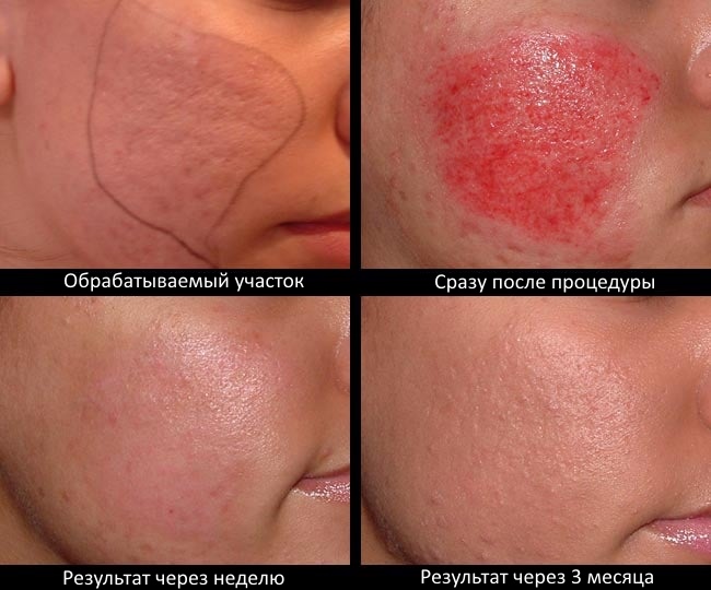 Mesoterapi muka pecahan - apa itu, bagaimana ia dilakukan, keberkesanan parut, kesan regangan, beg di bawah mata, harga kursus, gambar sebelum dan selepas, ulasan
