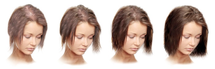 Minoxidil cho tóc: cách hoạt động, hiệu quả, trước và sau ảnh, đánh giá. Cách áp dụng cho phụ nữ và nam giới, tác dụng phụ, tác hại có thể xảy ra. Giá cả và đánh giá