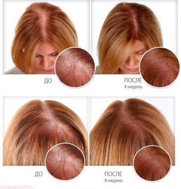 Minoxidil cho tóc: cách hoạt động, hiệu quả, trước và sau ảnh, đánh giá. Cách áp dụng cho phụ nữ và nam giới, tác dụng phụ, tác hại có thể xảy ra. Giá cả và đánh giá