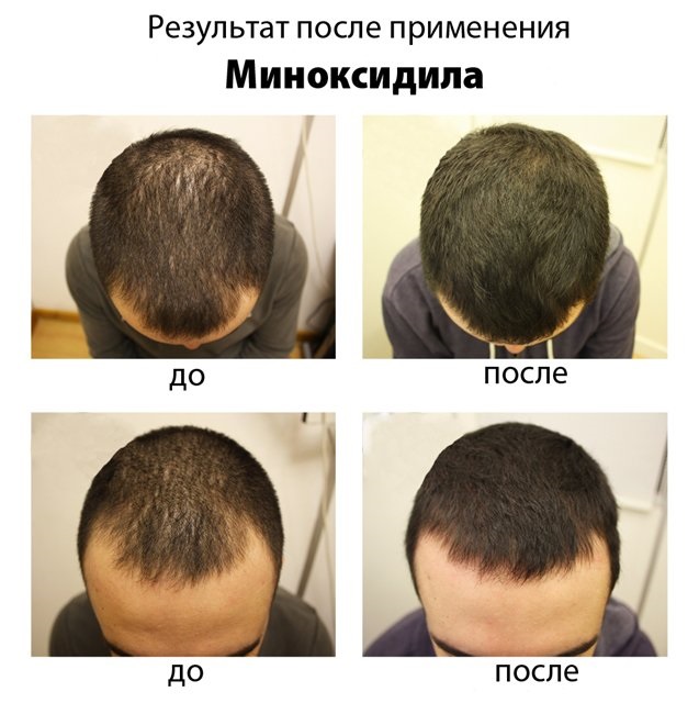 Minoxidil cho tóc: cách hoạt động, hiệu quả, trước và sau ảnh, đánh giá. Cách áp dụng cho phụ nữ và nam giới, tác dụng phụ, tác hại có thể xảy ra. Giá cả và đánh giá