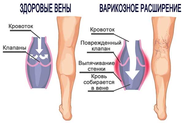 Облога за мршављење за стомак и бокове, ноге, руке. Како направити код куће, ефикасни рецепти, фотографије и прегледи