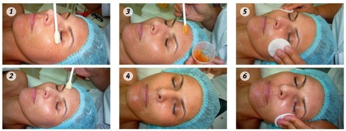 Lợi ích và tác hại của việc lột mặt: hóa chất, axit trái cây, glycolic, phần cứng, retinol, Jessner, axit succinic, với canxi