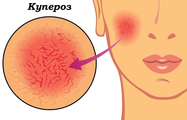Lợi ích và tác hại của việc lột mặt: hóa chất, axit trái cây, glycolic, phần cứng, retinol, Jessner, axit succinic, với canxi
