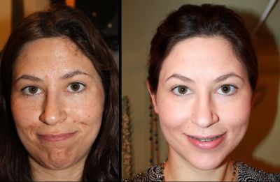 Lợi ích và tác hại của việc lột mặt: hóa chất, axit trái cây, glycolic, phần cứng, retinol, Jessner, axit succinic, với canxi