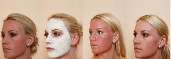 Lợi ích và tác hại của việc lột mặt: hóa chất, axit trái cây, glycolic, phần cứng, retinol, Jessner, axit succinic, với canxi