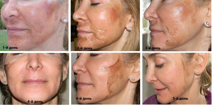 Lợi ích và tác hại của việc lột mặt: hóa chất, axit trái cây, glycolic, phần cứng, retinol, Jessner, axit succinic, với canxi